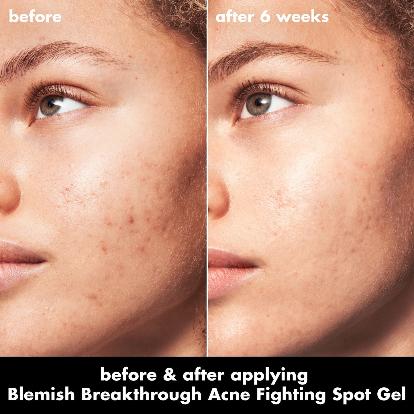 blemish-breakthrough-acne-fighting-spot-gel-v5 0326_EDU_BB_SpotGel_BA_MARLEY.jpg