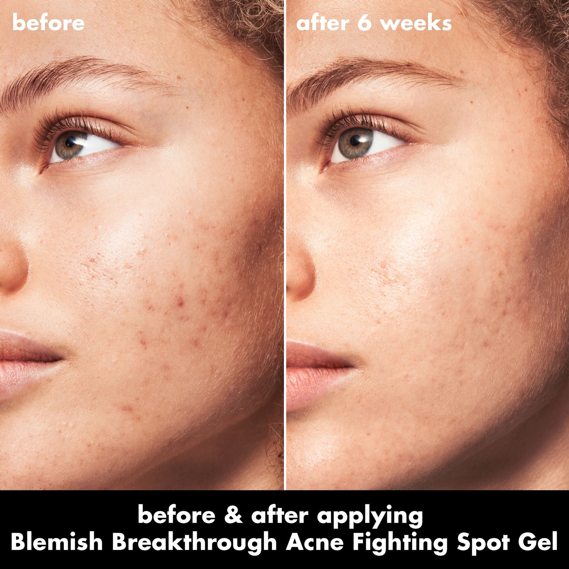blemish-breakthrough-acne-fighting-spot-gel-v5 0326_EDU_BB_SpotGel_BA_MARLEY.jpg