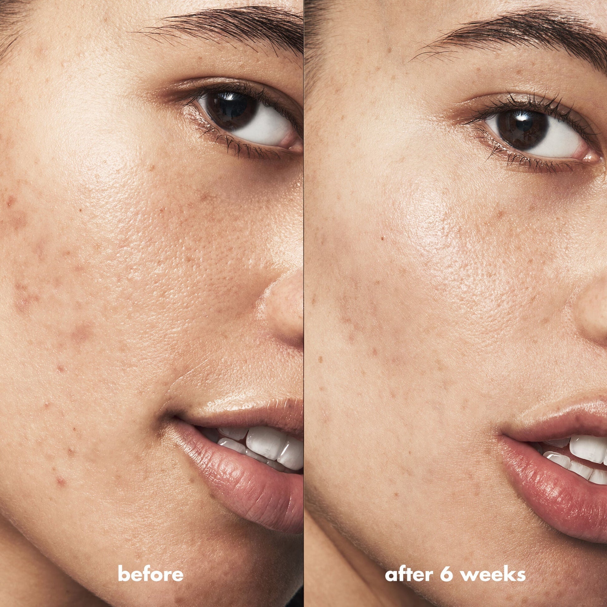 blemish-breakthrough-acne-calming-water-cream-m7 Acne_PDP_Isabella_Before_After_84ce713a-22d2-4bb9-aad7-445c7b27b1c9.jpg
