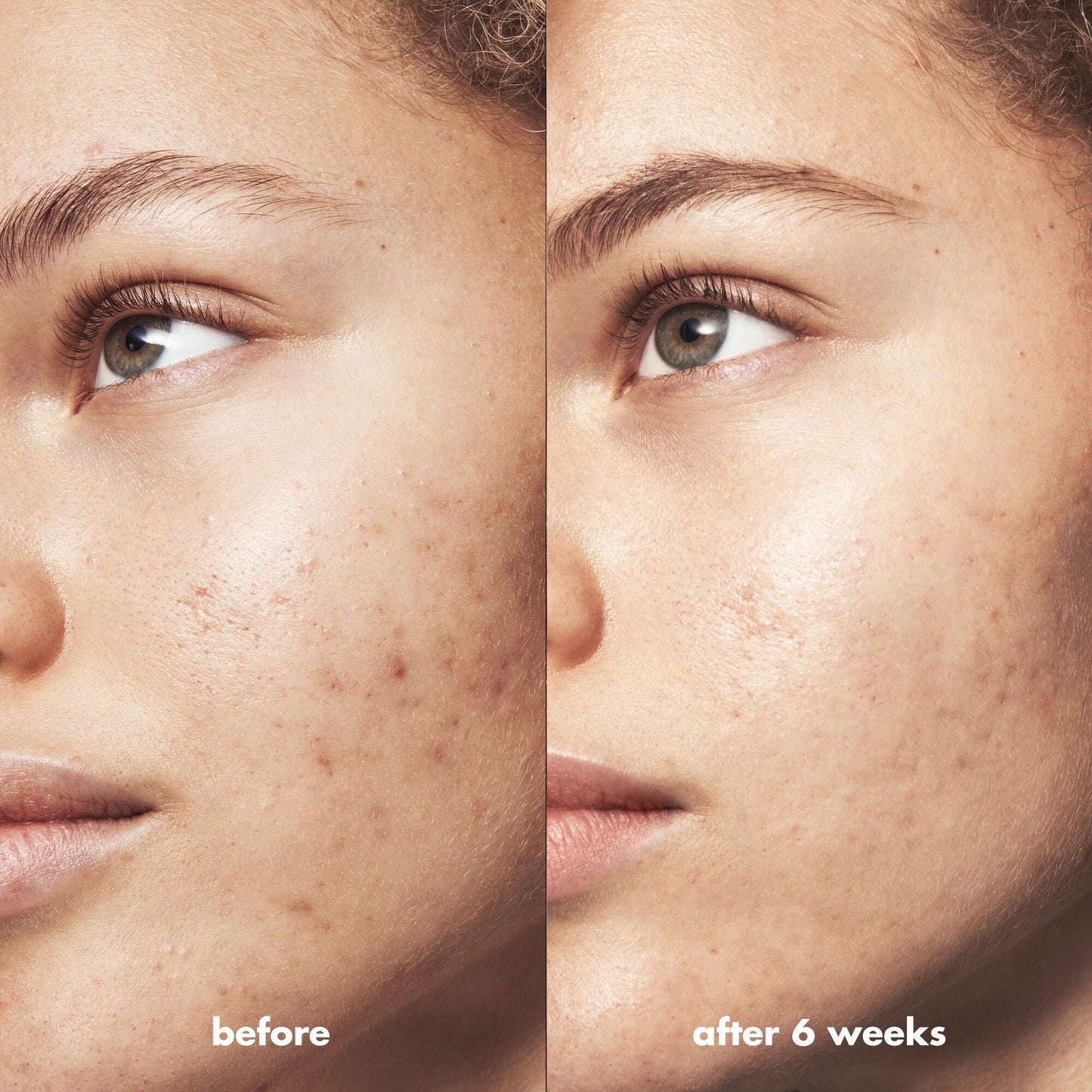 blemish-breakthrough-acne-calming-water-cream-mini-y9 Acne_PDP_Marley_Before_After_acf01478-a58b-47ce-99b5-2ef1dc022f9b.jpg